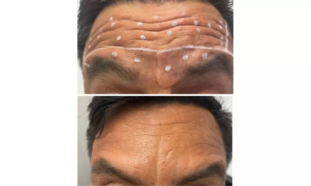 Lip Flip or 20–40 Units of Xeomin for a Smooth, Youthful Look