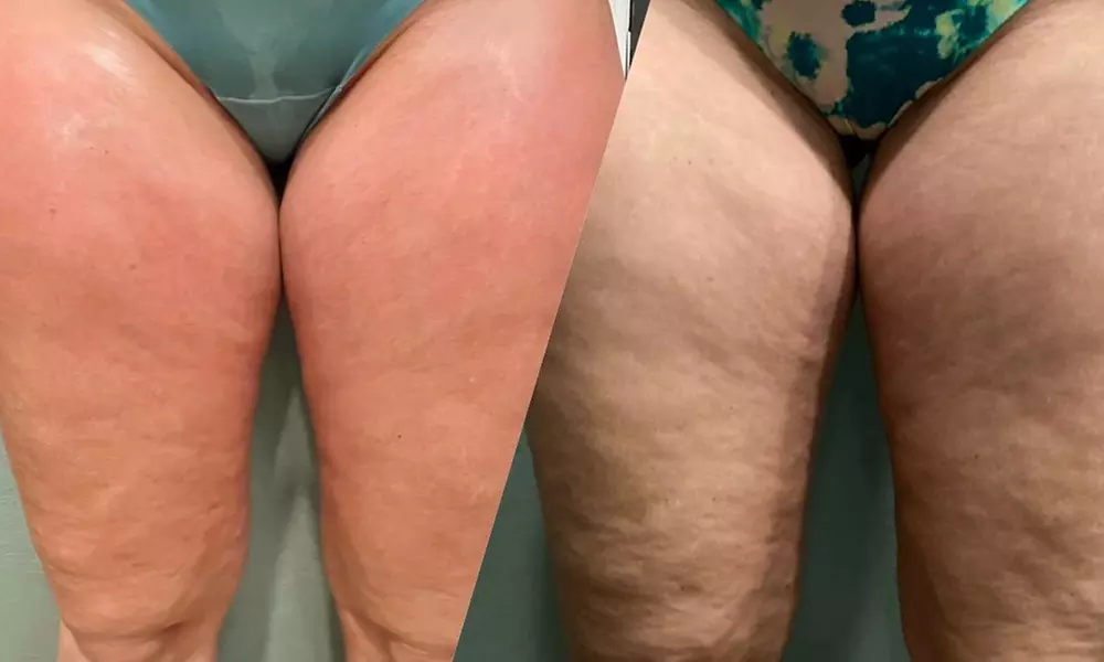 Smooth Skin with One or Three CelluClear Therapy Sessions