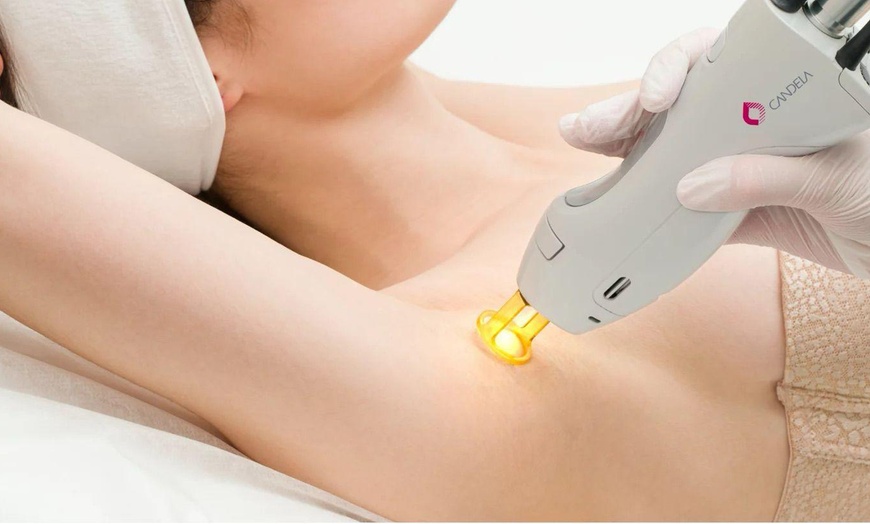 Image 1: Laser Hair-Removal: Underarms/Upper Lip/Chin or Bikini Area/Half Leg 