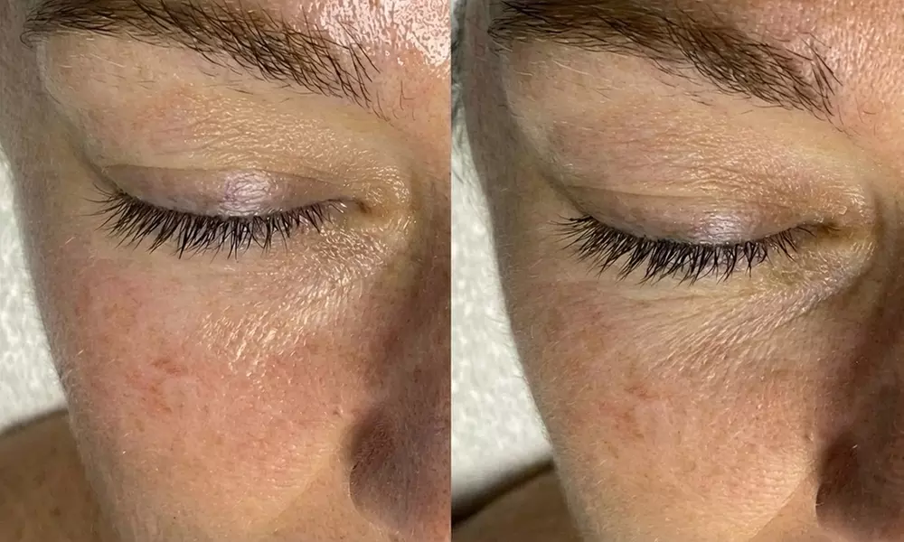 Radiant Skin w/ One, Two or Three 60 Min Basic Facial Sessions for One