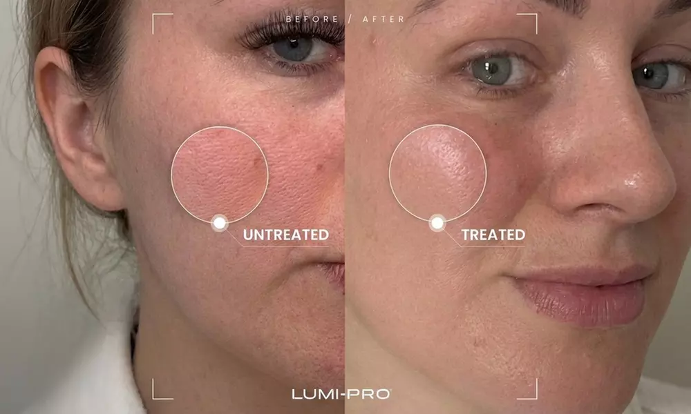 Polynucleotide Eye & Face Treatment Options