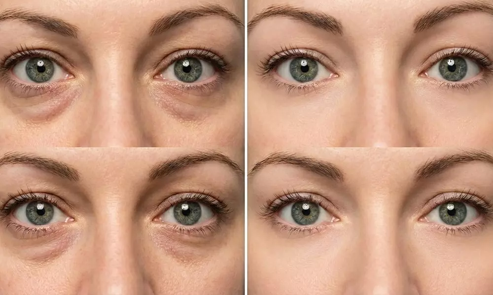 Polynucleotide Eye & Face Treatment Options