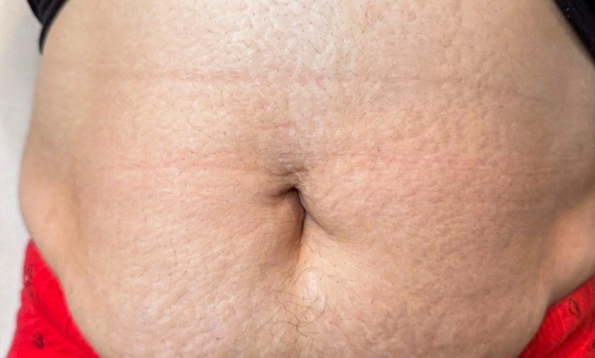 Image 2: Inkless Treatments for Stretch Marks & Scars on Various Body Areas