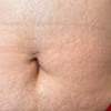 Image 2: Inkless Treatments for Stretch Marks & Scars on Various Body Areas