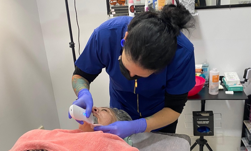 Image 2: Microlifting facial con dermapen y vitaminas, 1 o 2 sesiones