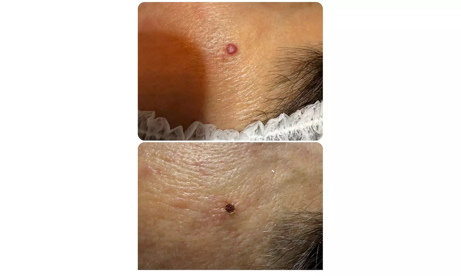 Plasma pen facial no quirúrgico para manchas y zona periocular