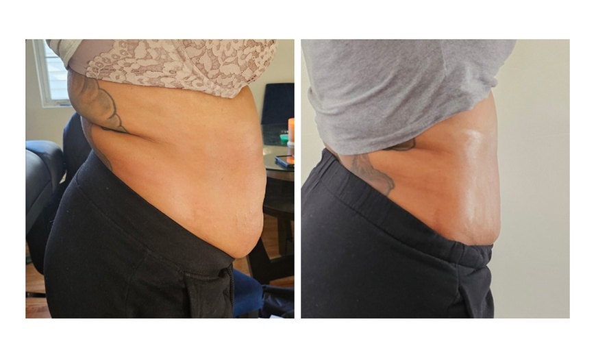 Image 2: Body Sculpting Combo Treatment