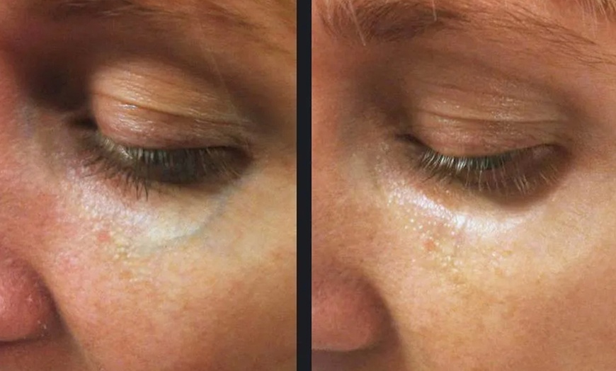 Image 5: Revitalize Your Skin With Nordlys IPL Treatments For Face And Body