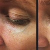Image 5: Revitalize Your Skin With Nordlys IPL Treatments For Face And Body