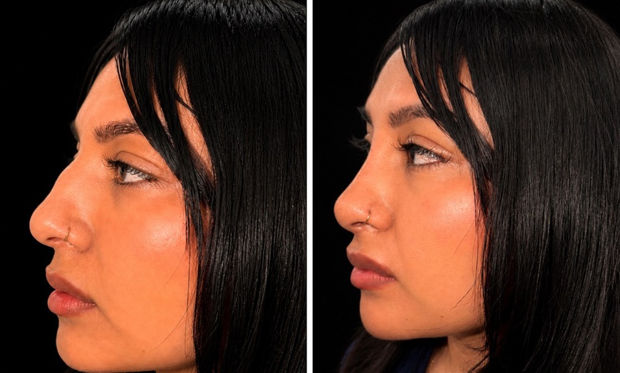 Image 4: Revanesse Versa Dermal Filler: Natural Lip & Facial Enhancement