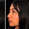 Image 4: Revanesse Versa Dermal Filler: Natural Lip & Facial Enhancement