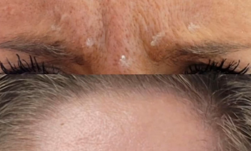 Image 2: Turn Back Time w/ 20, or 40 Units of Botox