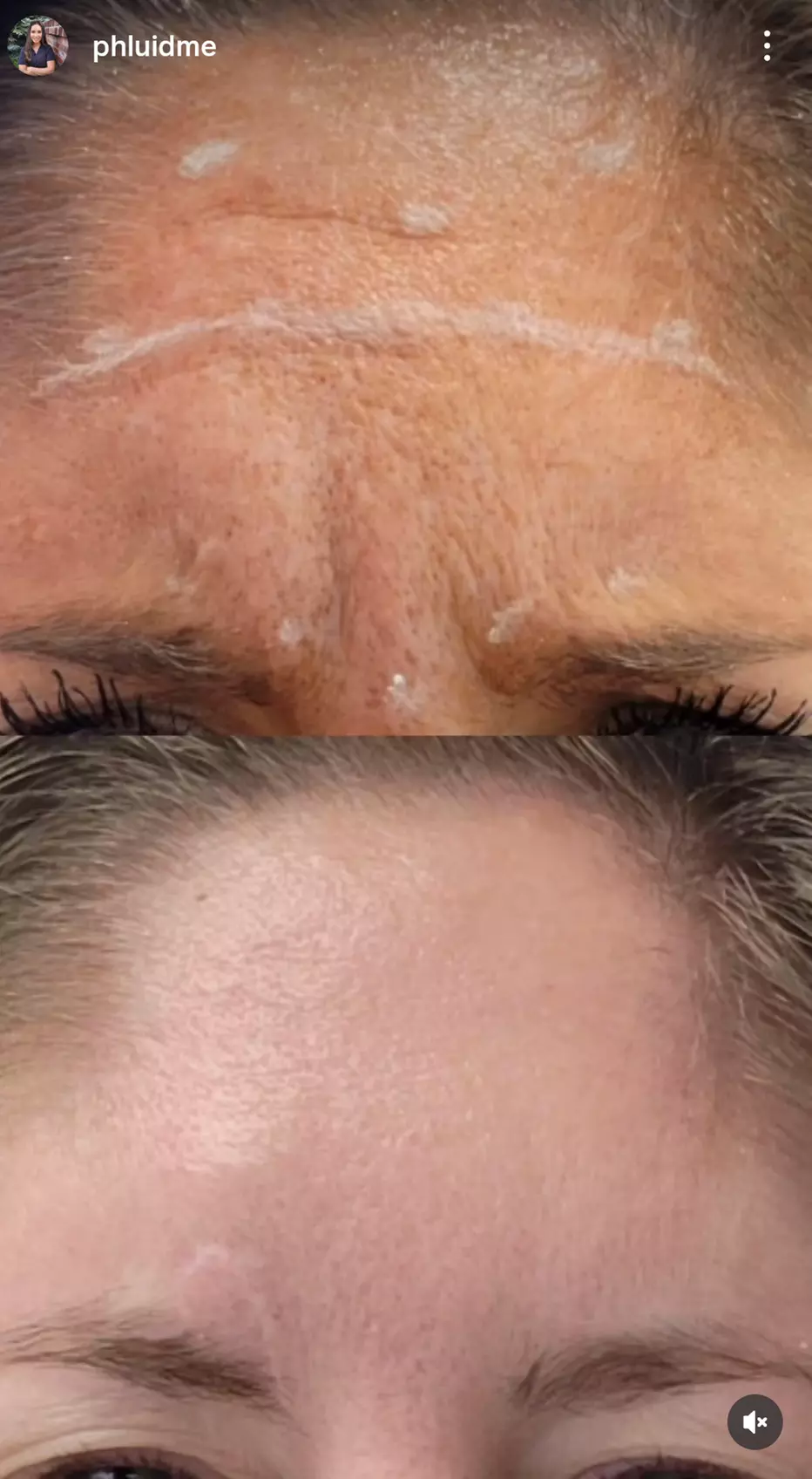 Turn Back Time w/ 20, or 40 Units of Botox