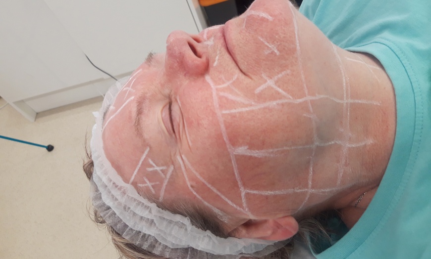 Image 2: Lift and Tone with Advanced HIFU for Face With or Without Neck