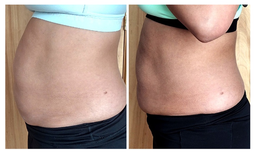 Image 4: RF Skin Tightening & Ultrasonic Cavitation