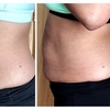 Image 4: RF Skin Tightening & Ultrasonic Cavitation
