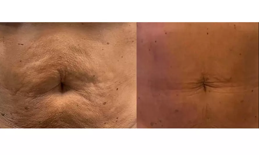 Up to 77% Off on Radio Frequency Skin Tightening