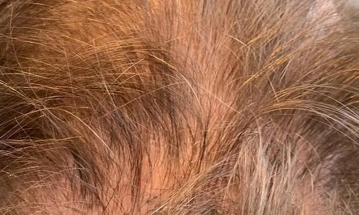 Scalp Micropigmentation