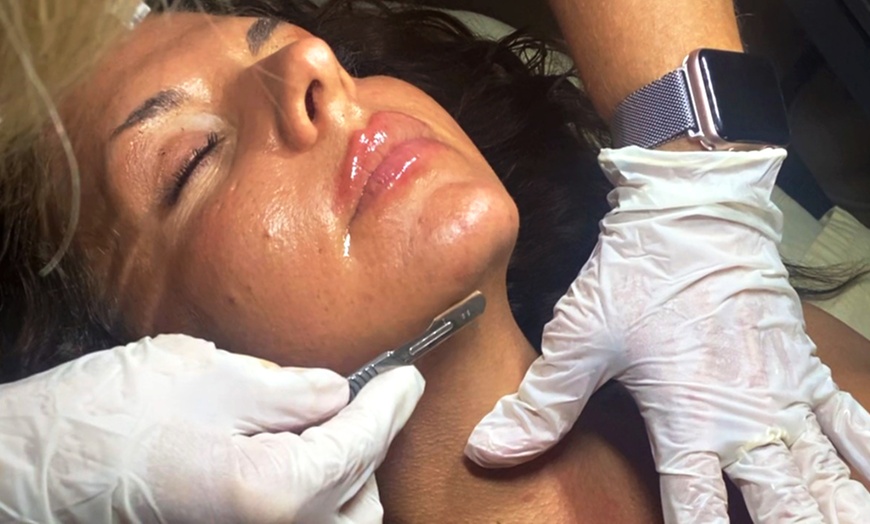 Image 3: Get 1, 2 or 3 Microdermabrasion or Dermaplaning Treatment with Facial 