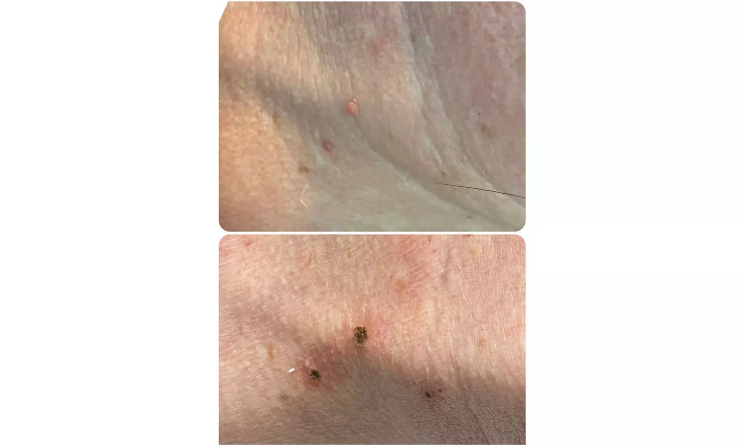 Plasma pen facial no quirúrgico para manchas y zona periocular