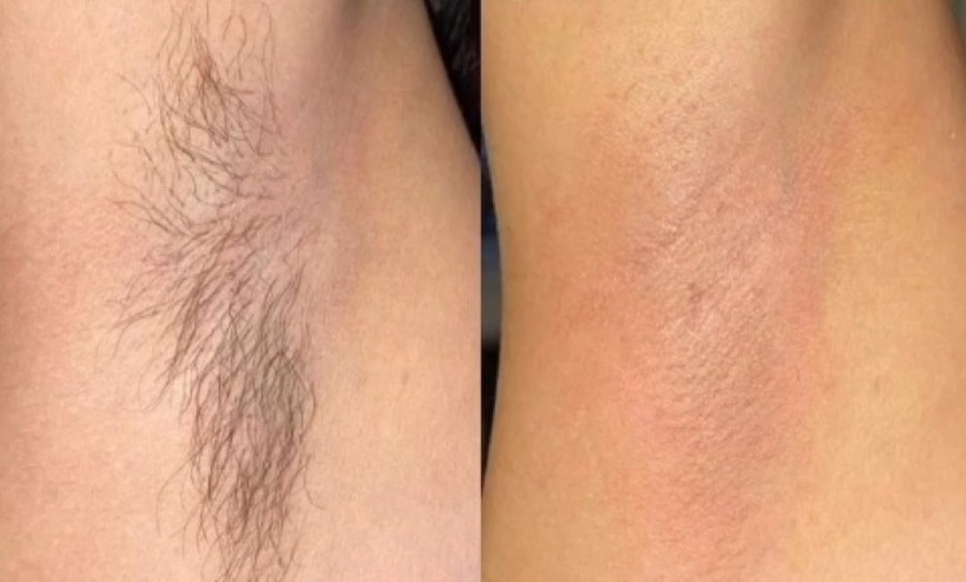 Image 2: Underarm & Upper Lip Waxing for Smooth, Refreshed Skin