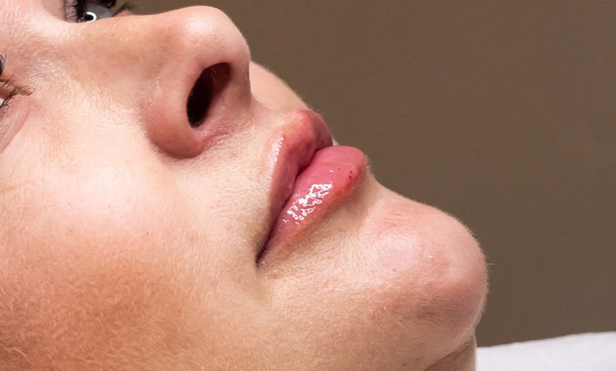 Image 1: Subtle Enhancement with 0.5ml, 1.1ml, or 2.2ml Filler Package