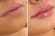Juvederm Lip Filler Injections at InStudio Aesthetics and Skin- Up to 60% Off - Image 4