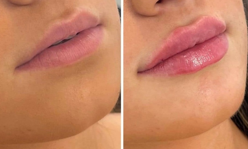 Image 4: Juvederm Lip Filler Injections for Enhanced Natural Beauty 