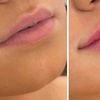 Image 4: Juvederm Lip Filler Injections for Enhanced Natural Beauty 