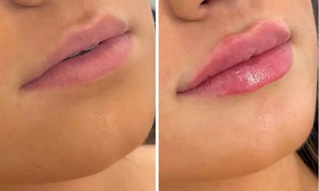Juvederm Lip Filler Injections for Enhanced Natural Beauty