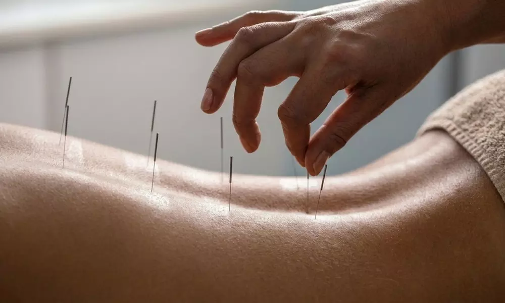 One, Three, or Five Acupuncture Sessions for Chronic Pain Relief