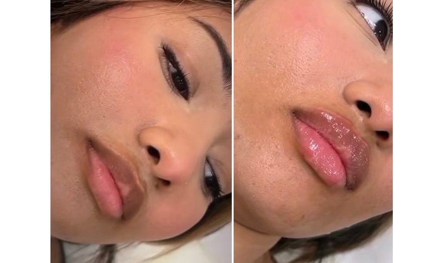 Image 3: Transform Smile: 0.5-, 1-, or 2-ml Dermal Filler or Dissolver & Refill