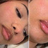 Image 3: Transform Smile: 0.5-, 1-, or 2-ml Dermal Filler or Dissolver & Refill