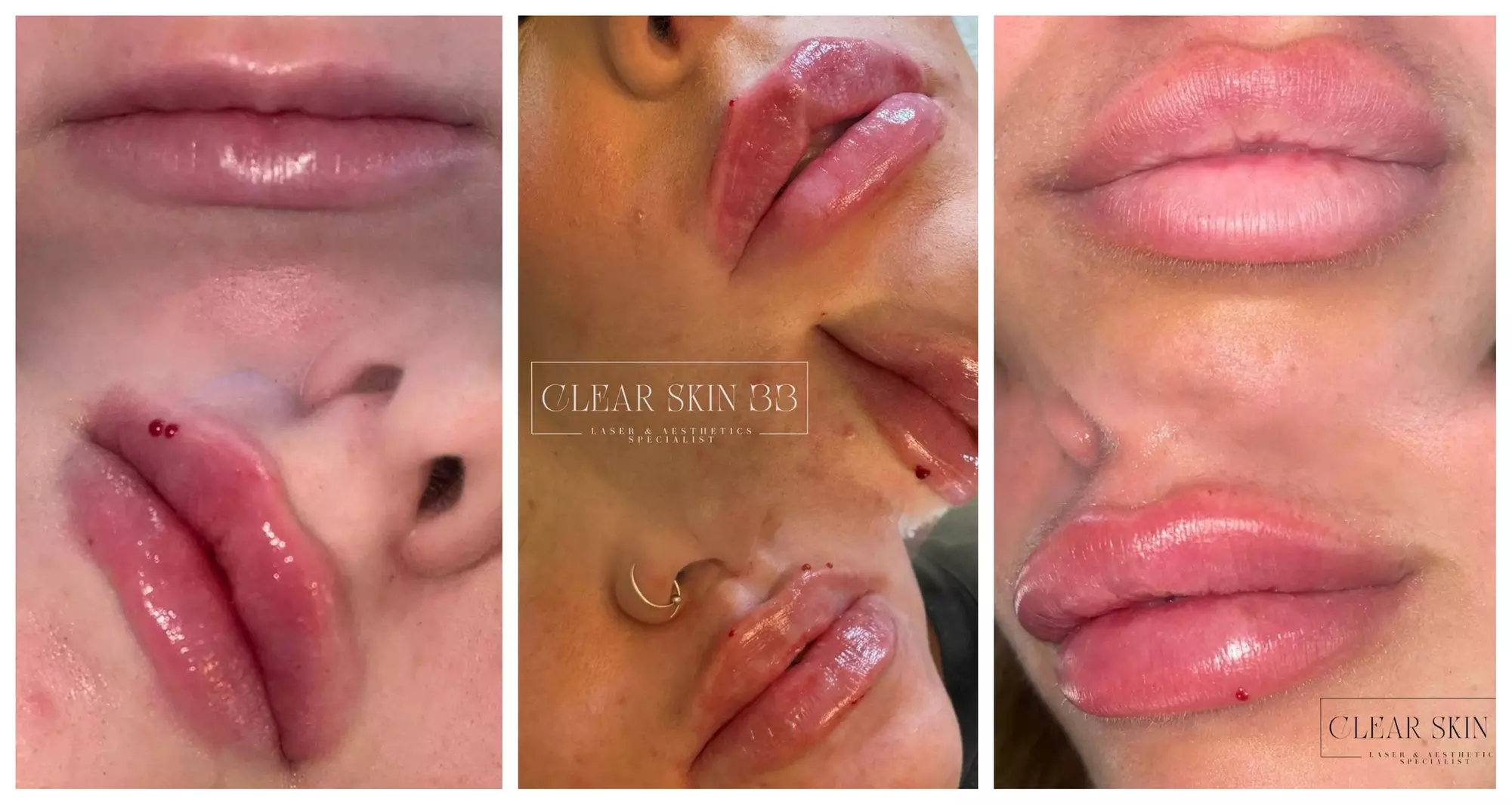 Up to 50% Off on Injection - Dermal Filler at Clear skin 33