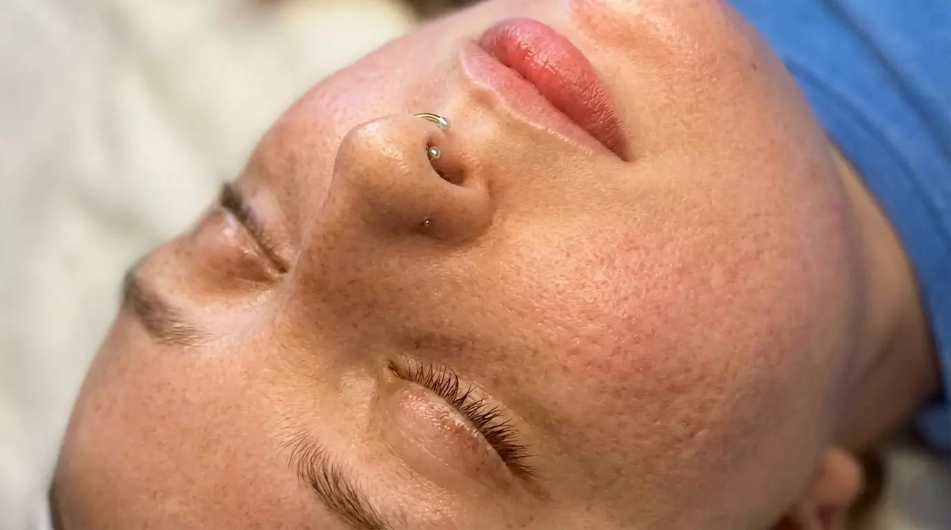 One, Two, Three or Four Professional Grade Pro Chemical Peels