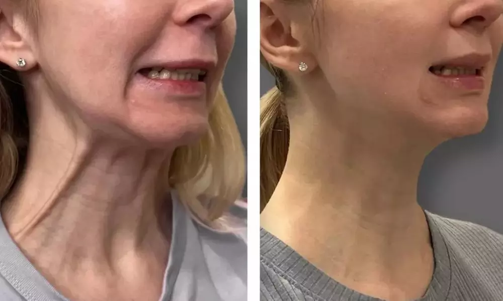  Revitalize Your Look with 20, 40, or 60 Units of Botox
