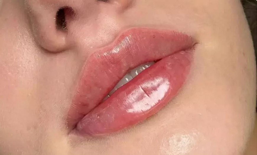 Image 2: Transform Your Look with 1ml or 2ml Dermal Fillers Lip, Cheek or Chin
