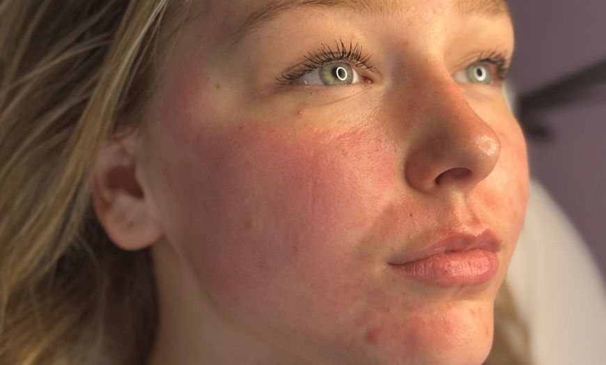 Image 2: One or Three Microneedling Sessions with Skin Booster