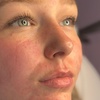Image 2: One or Three Microneedling Sessions with Skin Booster