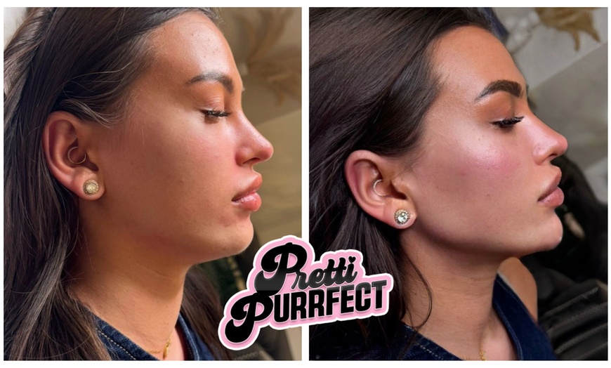 Image 4: One or Two Profhilo® Skin Revitalising Booster Sessions