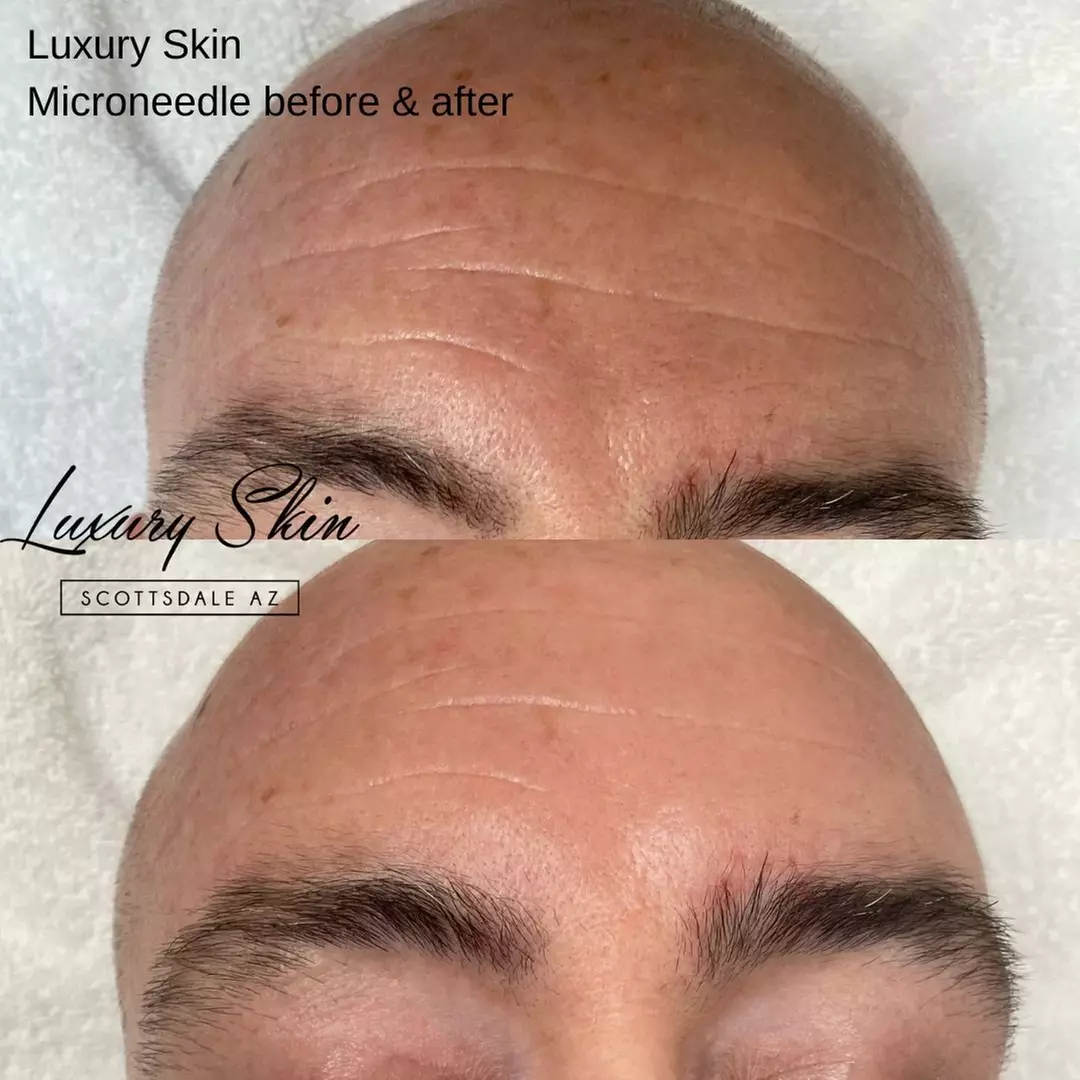 Up to 44% Off on Micro-Needling at Luxury Skin - Second Medium