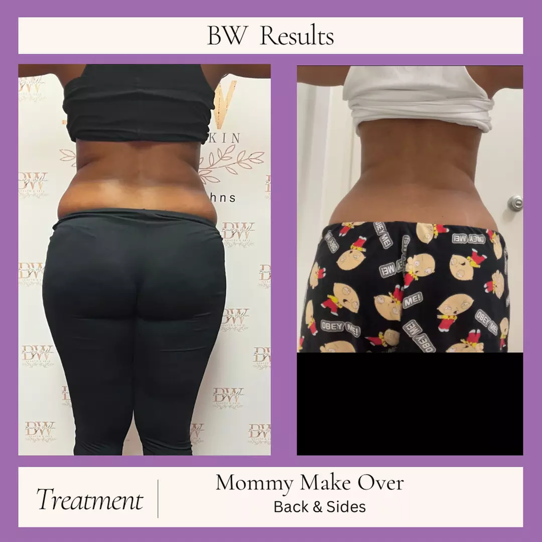 One, Three, or Six Mommy Makeover Sessions or Snatched To The Max