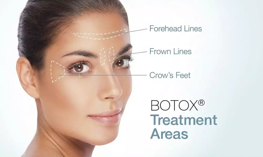 Up To 34% Off on Botox Injections: 20 or 40 Units for a Smoother & Natural Movement at Pure Health Medicine