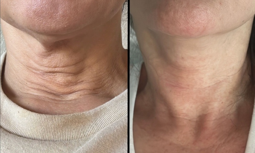 Image 3: 60-Minute Contouring Sessions with European Capenergy 2nd Gen 