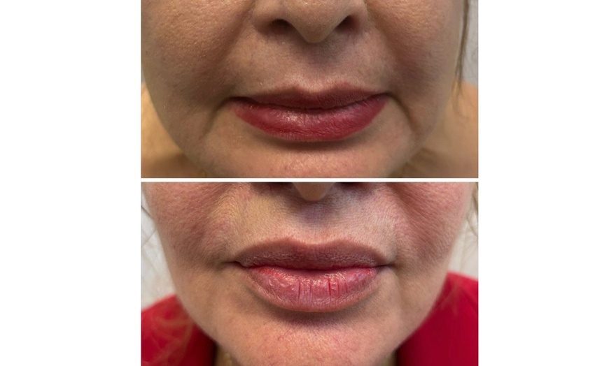 Image 8: Lip Flip or 20–40 Units of Xeomin for a Smooth, Youthful Look 