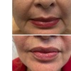Image 8: Lip Flip or 20–40 Units of Xeomin for a Smooth, Youthful Look 