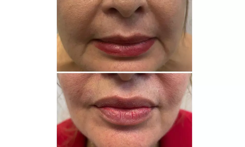 Lip Flip or 20–40 Units of Xeomin for a Smooth, Youthful Look