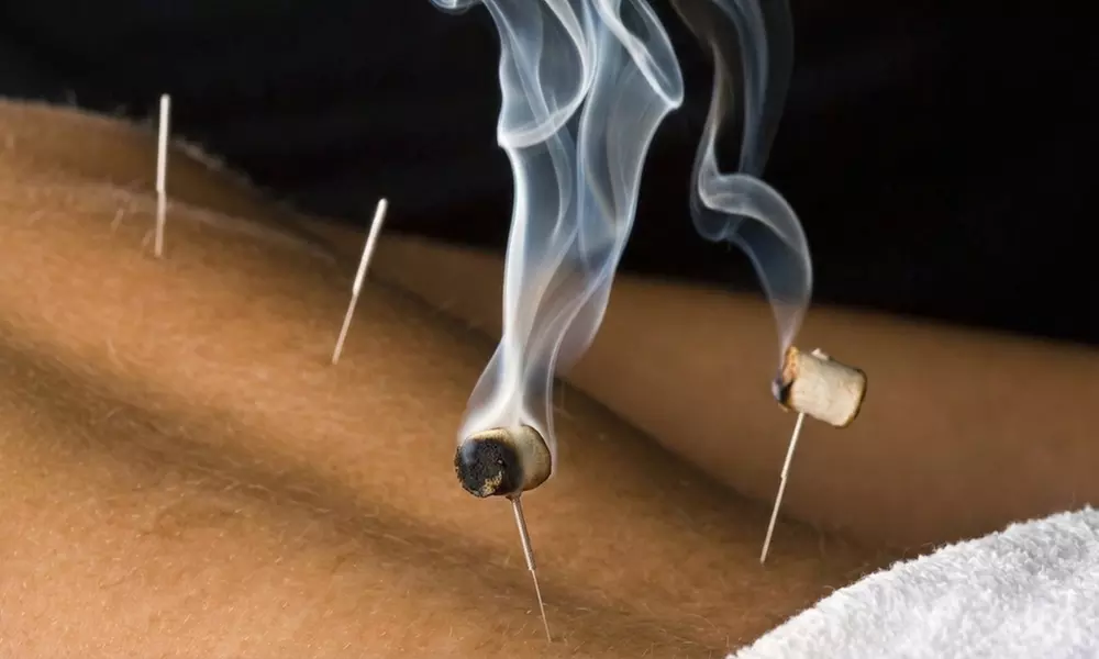 One, Three, or Five Acupuncture Sessions for Chronic Pain Relief