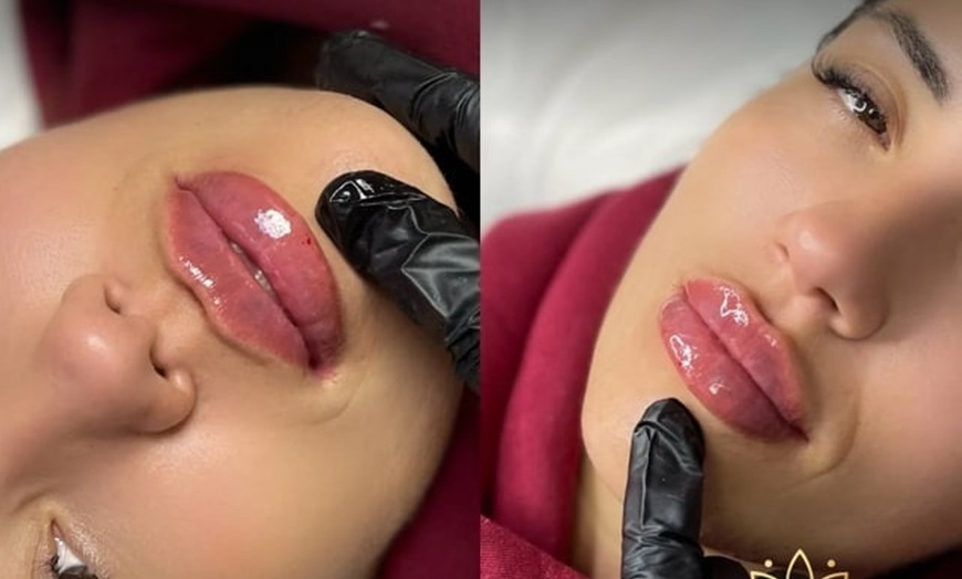 Image 8: Get a Dermal Filler Today: 1ml or 2ml Lips
