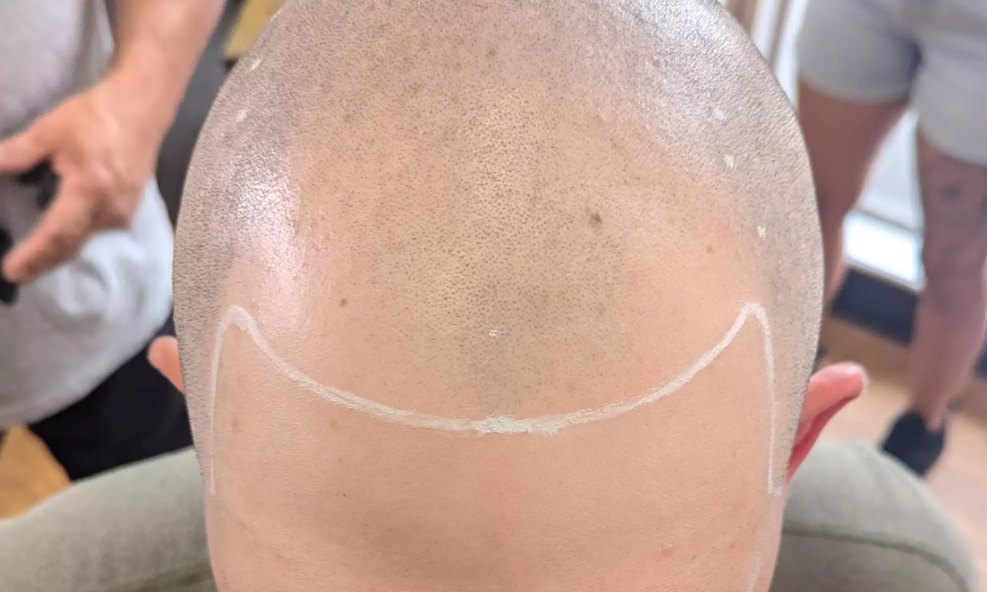 Scalp Micropigmentation Hair Loss, Balding, or Thinning Treatment